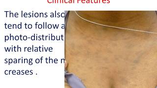 10 MIN REVISION Ashy Dermatosis A confusing hyperpigmentation [upl. by Navetse]