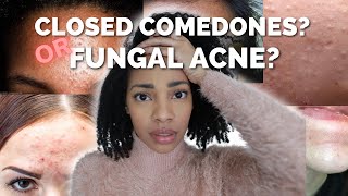 Fungal AcneMalassezia or Closed comedones Heres the difference [upl. by Nob]