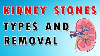 Kidney Stones  Types Diet and Removal Treatment [upl. by Bartel241]