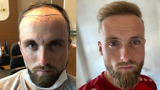 Hair Transplant Before and After  Month by Month Results  Elithair [upl. by Noevart954]