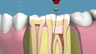 trattamento endodontico manuale e applicazione corona [upl. by Pierson116]