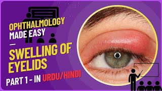 Understanding Eyelid Swellings A Comprehensive Guide to Hordeolum Chalazion Stye and Blepharitis [upl. by Atonsah]