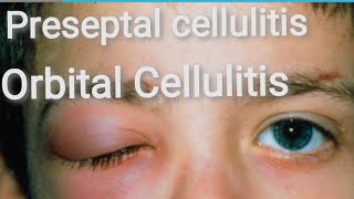 Orbit  Preseptal Cellulitis  Orbital cellulitis Part 5 [upl. by Mendive]