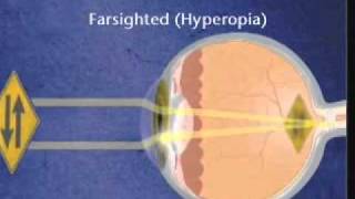 Farsightedness [upl. by Cohe]