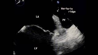 Warfarin ridge or LA clot to drahmadmirdamadisikcDwGso5hud2 [upl. by Waddell]