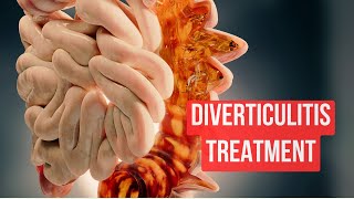 How To Treat Diverticulitis in 2024 [upl. by Eitsyrhc]