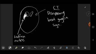 neuroradiology  Disappearing basal ganglia sign  early sign of infarction [upl. by Aliban]