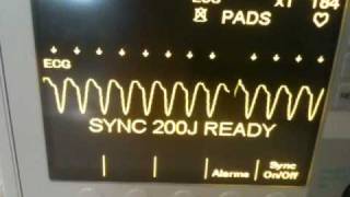 Ventricular Tachycardia cardioverted to Normal Sinus Rhythm per 2010 ACLS Guidelines [upl. by Diver]