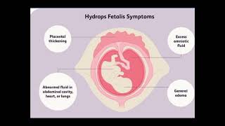 HYDROPS FETALIS ULTRASOUND FEATURES [upl. by Morita]