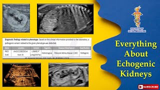 Everything about Echogenic Kidneys [upl. by Aloel]