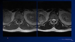 Neuroradiology board review 2 case 11 [upl. by Madaras969]