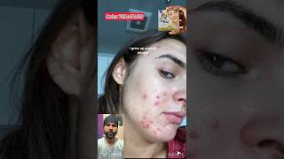 Original Goree cream pimple remove cream  pigmentation cream shortvideo shorts short [upl. by Yennaiv]