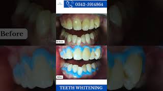 Teeth whitening before and after [upl. by Akkimat]