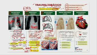 1 MAPA MENTAL DE QX TÓRAX Y CV TRAUMA TORÁCICO [upl. by Ora]