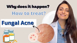 Fungal Acne  Why does it happen  How to treat  Dermatologist  Dr Aanchal Panth [upl. by Suk]