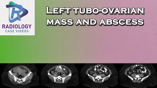 Left tuboovarian mass and abscess [upl. by Fleece724]