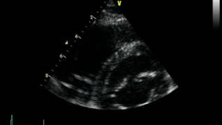 ARVC ARRHYTHMOGENIC RIGHT VENTRICULAR CARDIOMYOPATHY DAVD [upl. by Irakuy477]