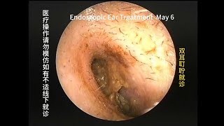 Common cerumen cleaning for narrow ear canal [upl. by Knarf]