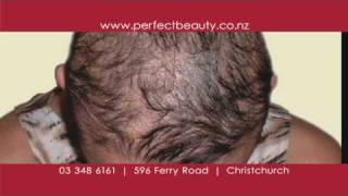 Natural Hair Loss Treatment for Men and Women  SRS Hair Clinic [upl. by Dnomed79]