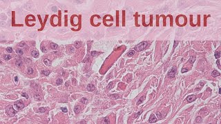 Leydig Cell Tumours of the Testis  Pathology mini tutorial [upl. by Buckie616]