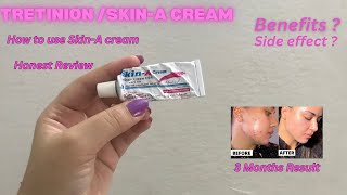 Skin A Cream Review  Acne Treatment at home  How to Use Tretinoin  Tretinoin Cream [upl. by Ahsirt]