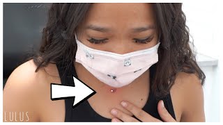 Fixing A Dermal Piercing That Came Out After A Year [upl. by Grados]