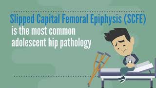 The British Orthopaedic Surveillance Study slipped capital femoral epiphysis [upl. by Emmeram481]