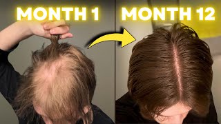 I Stopped Hair Loss in 30 Days with These Treatments [upl. by Ahtelat]