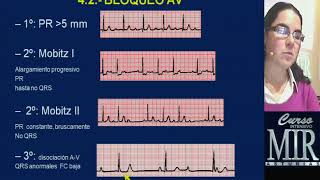 MIR ASTURIAS  INTERPRETACIÓN EKG [upl. by Seavir]