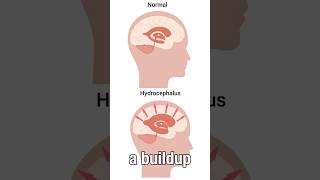 What is Normal Pressure Hydrocephalus [upl. by Saref]