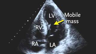 Transthoracic Echocardiogram [upl. by Kohl]