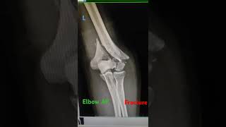 distal humerus fracture xray subscribe supportmychannel support ytshortsindia [upl. by Clapp]