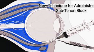 New Technique for Administering a SubTenon Block By Samir A Nazarali MD [upl. by Ivgnout]