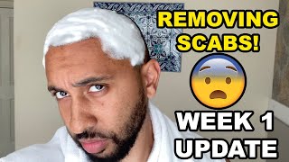 Afro Hair Transplant Day 7 Scab Removal [upl. by Jeritah]