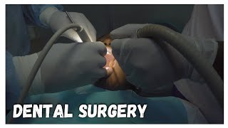 Dental Surgery  Amalgam Filling  Scaling and polishing [upl. by Aneerhs941]