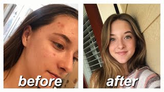 ACCUTANE FOR MILD ACNE  my story amp monthly updates [upl. by Skippy745]