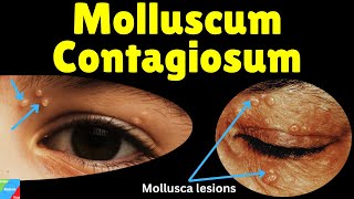 Molluscum Contagiosum Water Warts – Symptoms Causes Diagnosis Treatment amp Complications [upl. by Madelon]