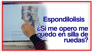 Espondilolistesis l4  l5 l5  s1 La Importancia de Tratarla y Opciones de Tratamiento Avanzadas [upl. by Josselyn]