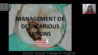 Management of DEEP CARIOUS LESION [upl. by Braden857]