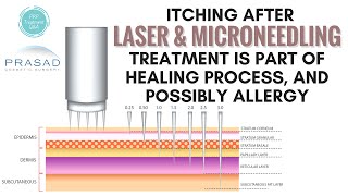 Why Itching is Part of the Healing Process of Facial Microneedling and Laser Resurfacing [upl. by Edmon548]