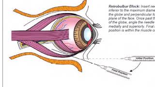 Retrobulbar block in dog prior to enucleation [upl. by Eleanora261]