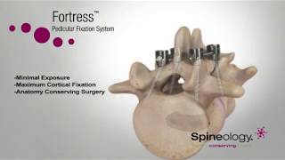 Spineology Fortress Pedicular Fixation System Animation [upl. by Rodrigo974]