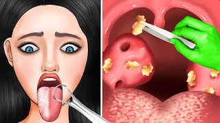 ASMR Powerful Tonsil Stone Treatment amp Giant Tartar Removal Animation  ASMR Animation [upl. by Diet843]