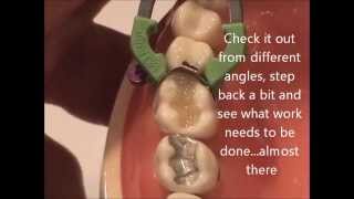 Maxillary Composite Placement WREB [upl. by Caylor925]