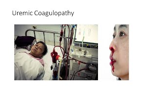 Uremic Coagulopathy [upl. by Ainoek]