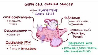 Germ cell ovarian tumors [upl. by Portie396]