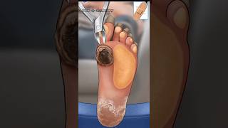 ASMR I Surgery to Remove Large Plantar Warts Animation relaxingasmr5063 mengstopmotion [upl. by Kotta]