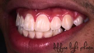 Resin infiltration for esthetic treatment of fluorosis [upl. by Isdnyl]