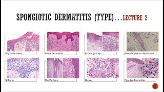 5 Spongiotic Dermatitis 2 [upl. by Kendell655]