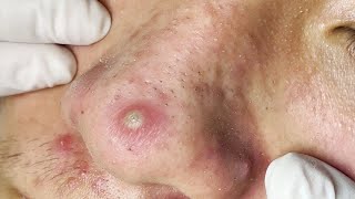 Big Cystic Acne Blackheads Extraction Blackheads amp Milia Whiteheads Removal Pimple Popping  2740 [upl. by Cantone]